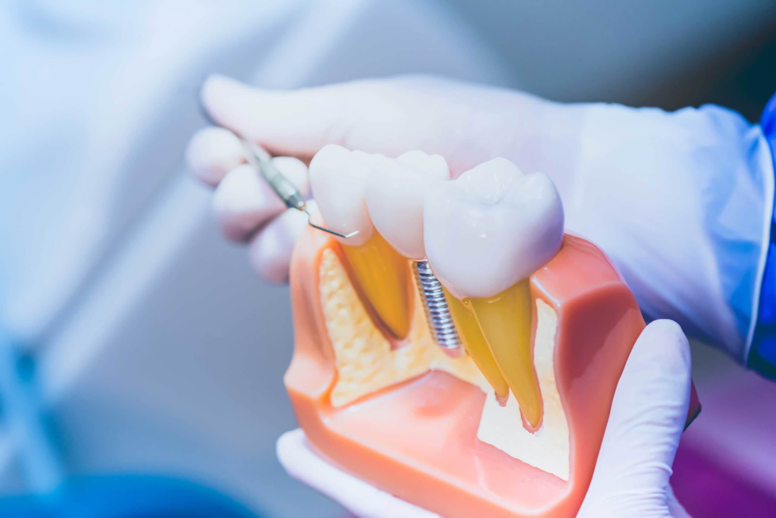 Dental implant instructional graphic